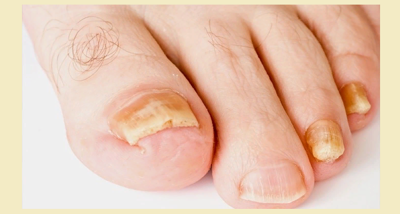  грибок ногтей на пальцах ног