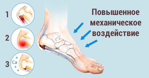 Шпора пяточная лечение в домашних условиях желчью