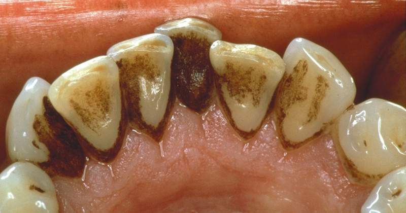 Как без помощи стоматолога можно удалить зубной налёт? зубной налёт, зубы, полезный пост, самолечение, стоматолог, стоматология