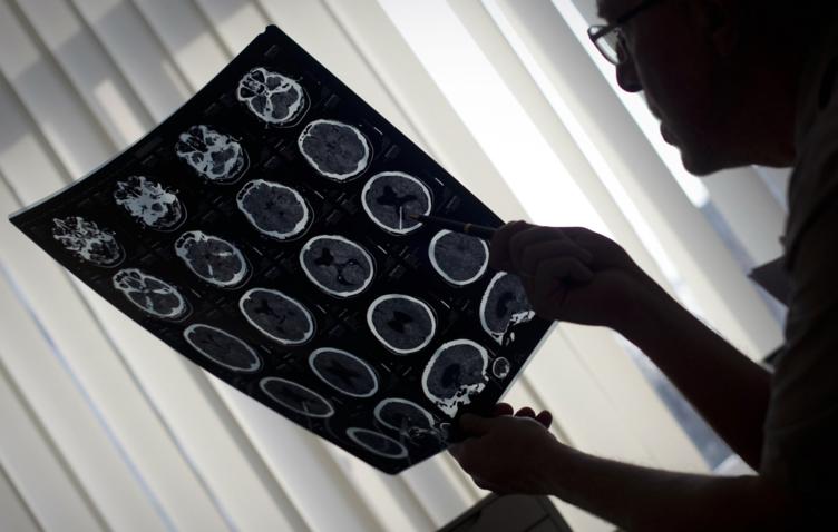 Ультразвук может повысить выживаемость после инсульта, очищая мозг