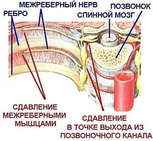 МЕЖРЕБЕРНАЯ НЕВРАЛГИЯ. Народные методы лечения МЕЖРЕБЕРНАЯ НЕВРАЛГИЯ. Народные методы лечения