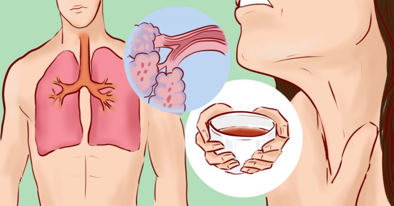 9 домашних средств, которые помогают вывести мокроту из груди и горла