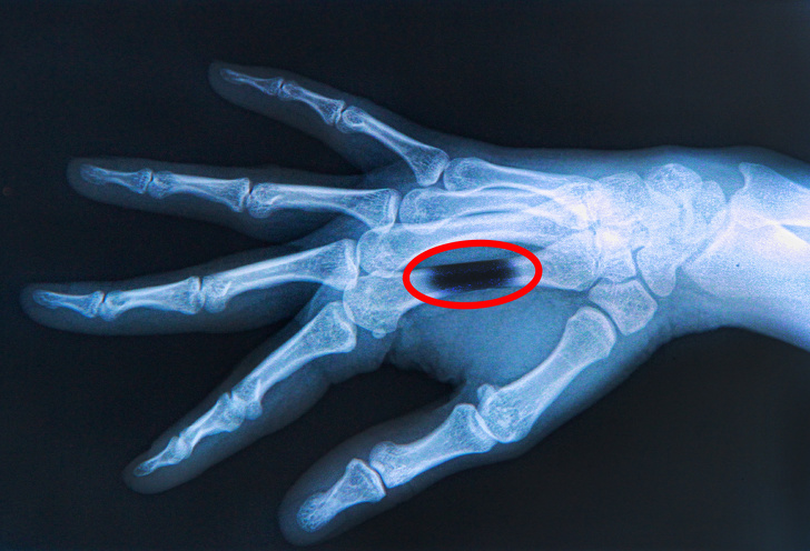 Непредсказуемые побочные эффекты, которые могут возникнуть после укусов животных Непредсказуемые побочные эффекты, которые могут возникнуть после укусов животных