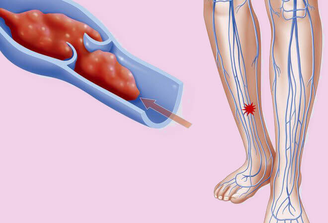 Первые симптомы тромба в ноге
