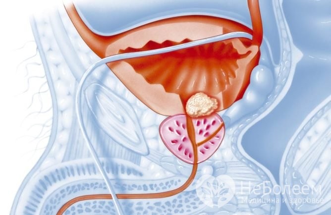 Причины развития простатита