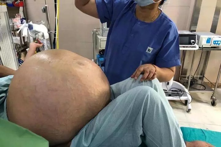 52-летней жительнице Индии удалили опухоль яичников весом 50 кило