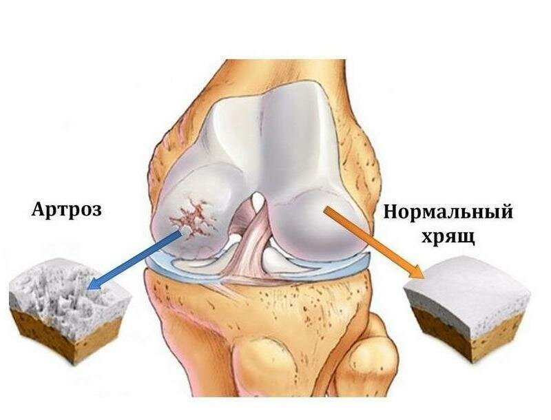 Разрушение хрящевой прокладки при артрозе