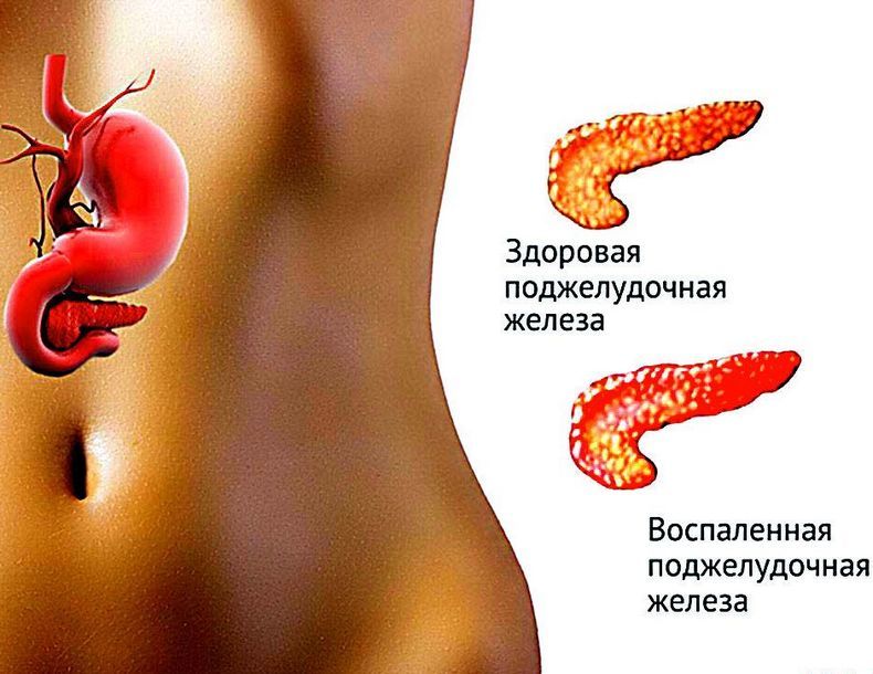 Лечение поджелудочной железы: Лучшие травы и рецепты Лечение поджелудочной железы: Лучшие травы и рецепты