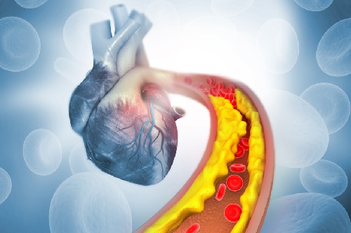 Высокий уровень холестерина в крови: как можно вернуть здоровье