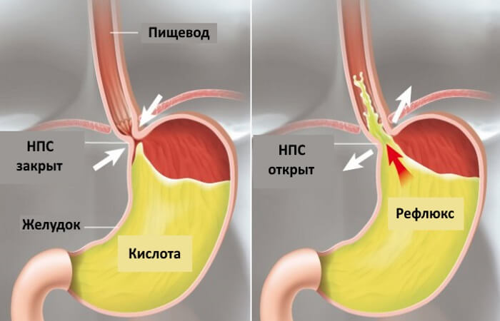 Как лечить рефлюкс: 8 советов
