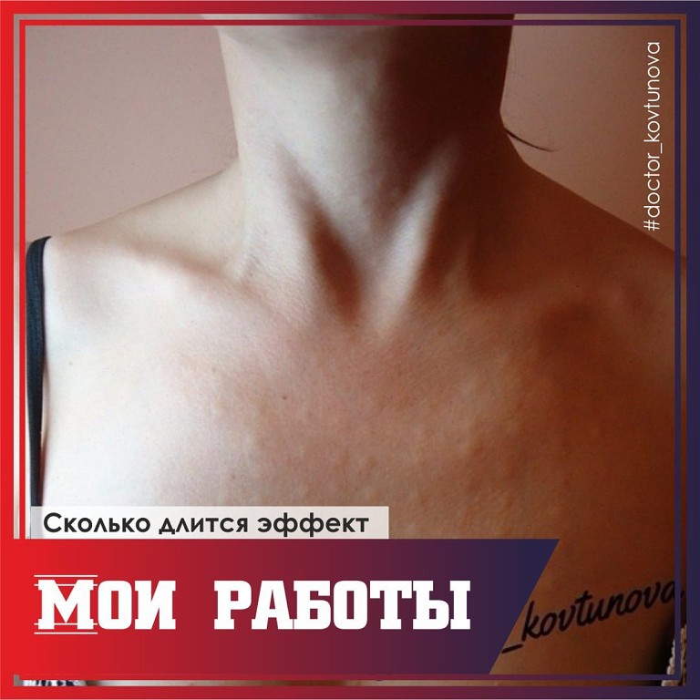Процедура биоревитализации