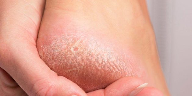 Как бороться с сухими мозолями и как избежать их появления
