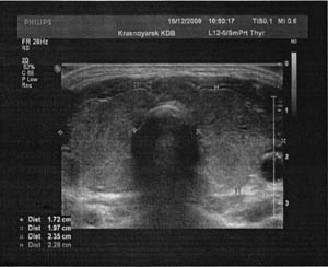 ��� ���������� ������. Uzi thyroid