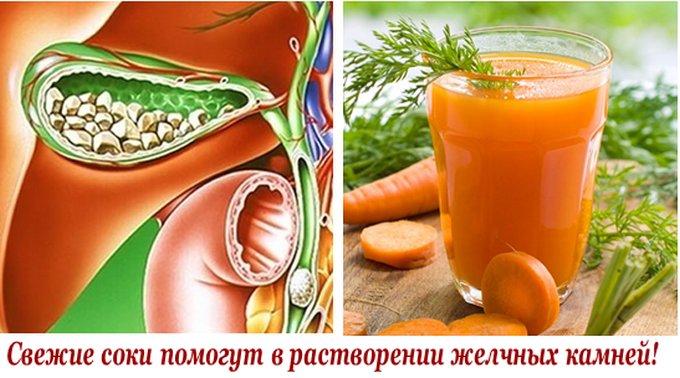 Как народными средствами растворить камни в желчном пузыре Как народными средствами растворить камни в желчном пузыре