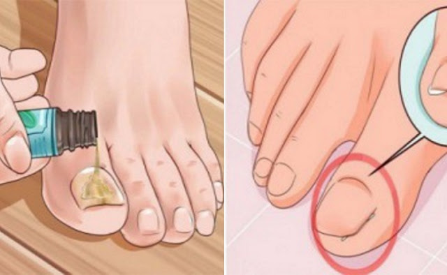 How to Get Rid of a Painful Ingrown Toenail as Fast as Possible Without Seeing a Doctor