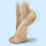 lechenie-natoptyishey-v-domashnih-usloviyah-9-150x150