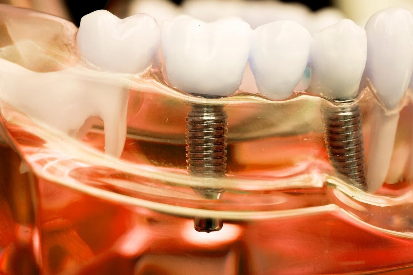 Импланты жевательных зубов