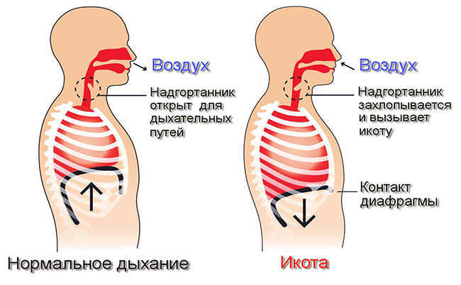 100% быстрое избавление от икоты икота, избавление