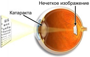 Как не пропустить начало развития катаракты, что должно настораживать?