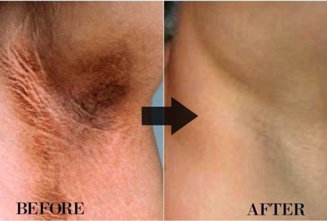i-m-gonna-use-it-forever-10-minutes-magic-to-get-rid-of-dark-underarms