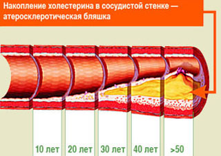 Ateroskleroticheskaya-blyashka (320x227, 27Kb)
