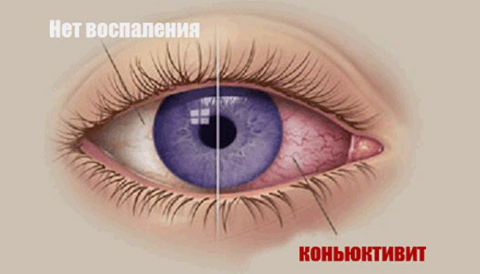 Коньюктивит. Причины, симптомы и лечение коньюктивита в домашних условиях Коньюктивит. Причины, симптомы и лечение коньюктивита в домашних условиях