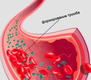 Разжижение крови народными средствам Разжижение крови - семь рецептов народной медицины и правила лечебного питания.