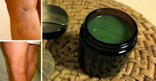 mother-heals-varicose-veins-simple-recipe-old-granny-results-almost-immediate-1024x546
