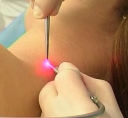 Папилломы: причины и лечение народными средствами Вирус папилломы - распространенное заболевание, бороться с которым можно и нужно медицинскими и народными способами.