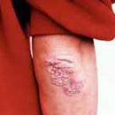 Plaque Psoriasis Pictures: 9