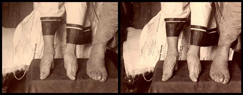 Китайские "лотосовые ножки" -"lily feet"- и ужасающие подробности этого обычая Китайские "лотосовые ножки" -"lily feet"- и ужасающие подробности этого обычая
