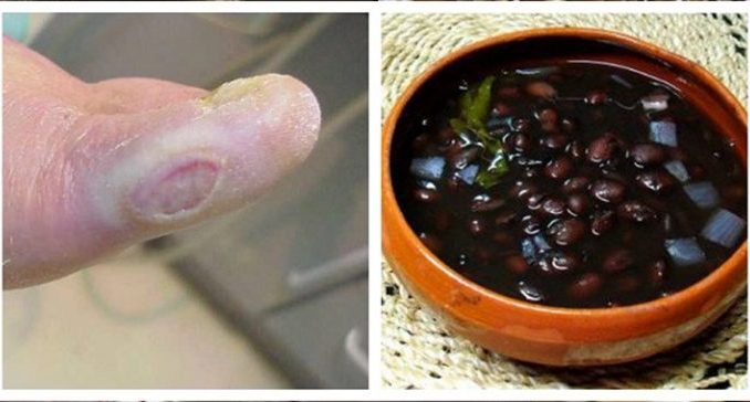 drevnij_recept_pomozhet_derzhat_saxar_v_norme_ili_kak_vylechit_saxarnyj_diabet__naget_ru