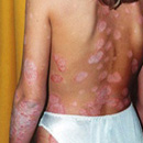 Plaque Psoriasis Pictures: 7