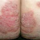 Plaque Psoriasis Pictures: 8