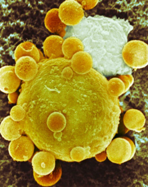 Раковая клетка, выпускающая экзосомы (фото Dr Andrejs Liepins). 