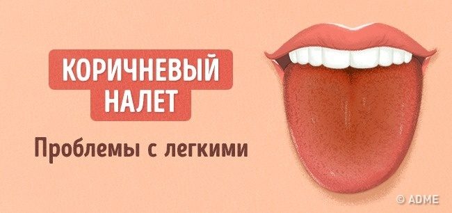 Что расскажет цвет языка о вашем здоровье