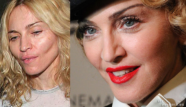 Madonna Plastic Surgery