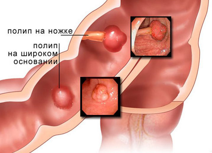 Полипы в желудке