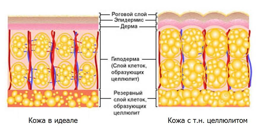 Целлюлит, как самый большой обман 21 столетия