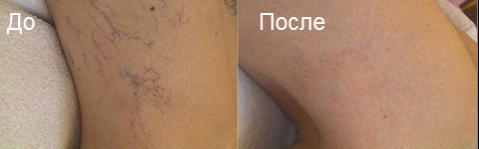 Чем убрать звездочки на ногах в домашних условиях Чем убрать звездочки на ногах в домашних условиях