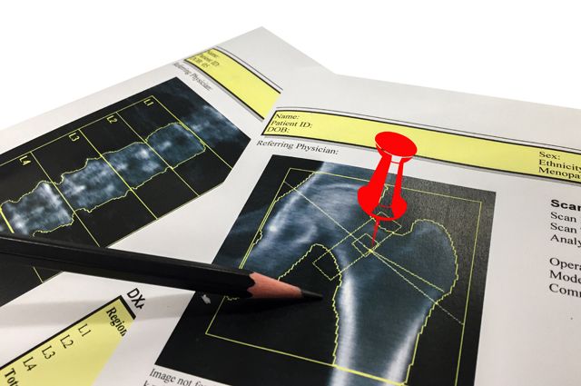 Почему развивается остеопороз и как его предотвратить