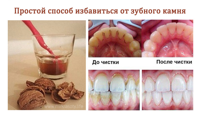 Как камень с зубов народное средство Как камень с зубов народное средство