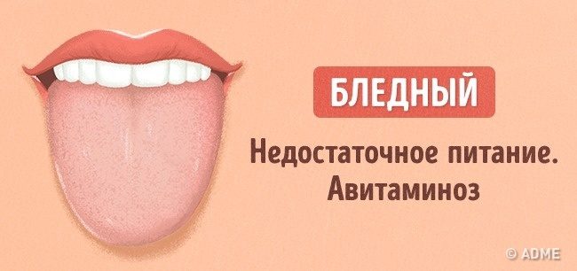 Что расскажет цвет языка о вашем здоровье