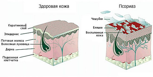 ПСОРИАЗ, ИЛИ ЧЕШУЙЧАТЫЙ ЛИШАЙ. Симптомы заболевания и методы лечения Народные рецепты при псориазе