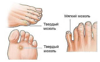 НАРОДНЫЕ МЕТОДЫ ОТ МОЗОЛЕЙ