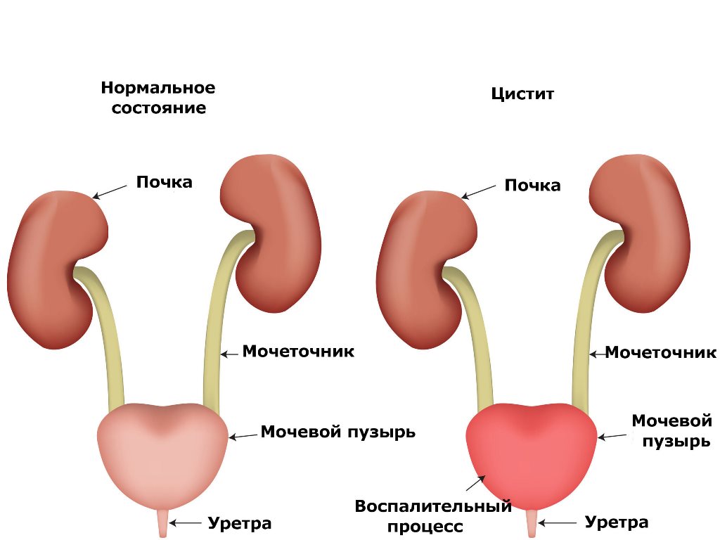 лечение частого мочеиспускания Цистит - одна из причин частого мочеиспускания