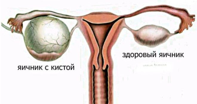 Лечение кист яичника в домашних условиях Лечение кист яичника в домашних условиях