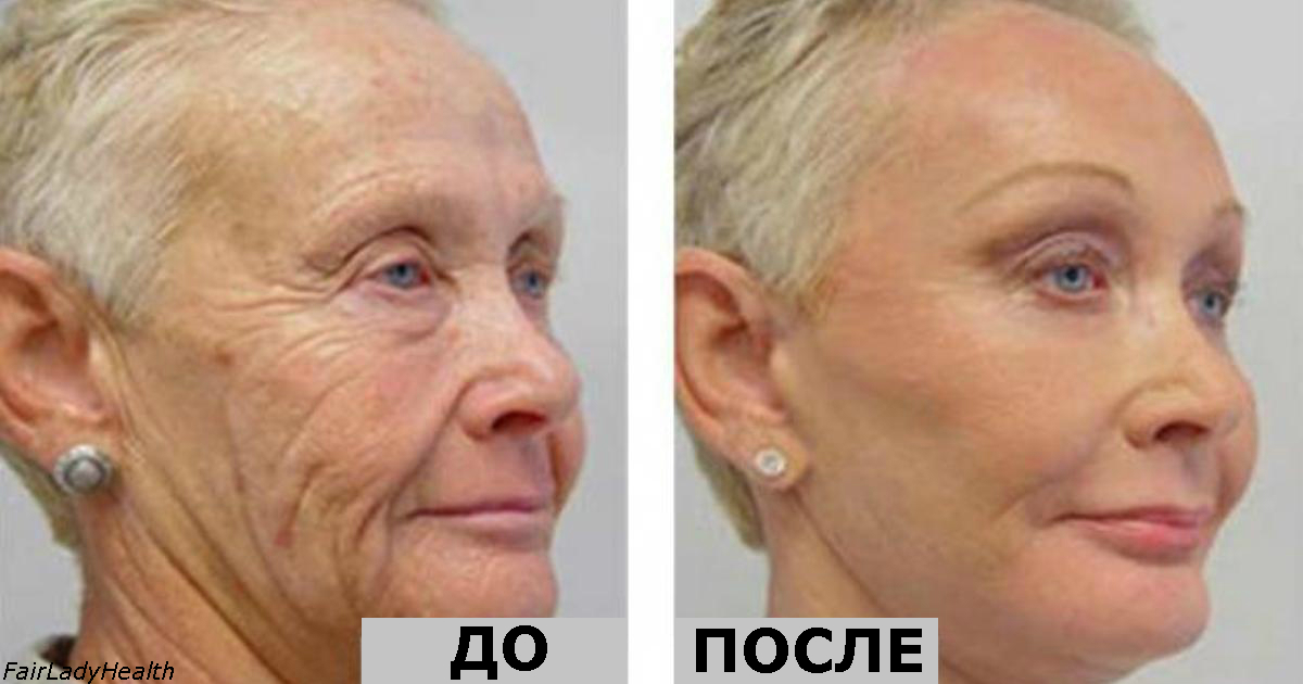 Ей 64, но все завидуют ее лицу без морщин! Ее тайна - один-единственный ингредиент! Ей 64, но все завидуют ее лицу без морщин! Ее тайна - один-единственный ингредиент!