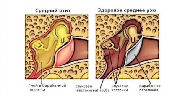 Лечим отит у ребенка в домашних условиях Лечим отит у ребенка в домашних условиях