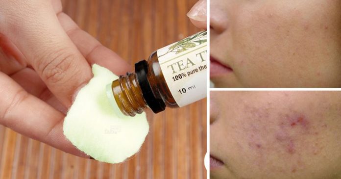 10-reasons-put-tea-tree-oil-skin-right-now